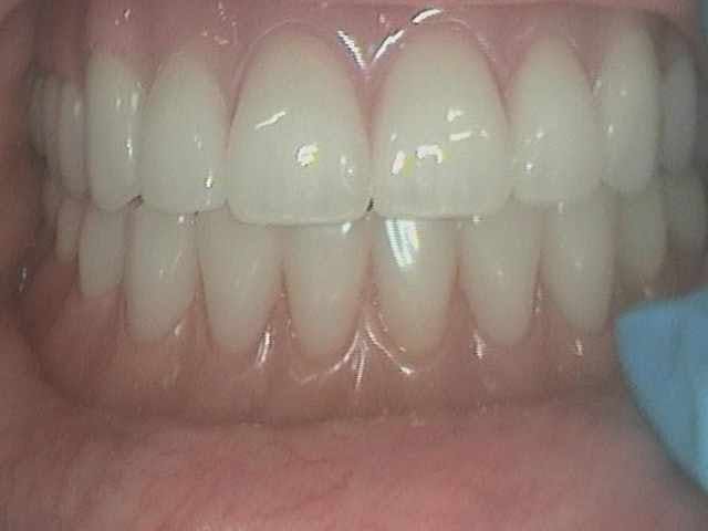 Complete Denture