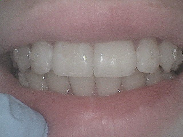 Dental Bridges Before 01