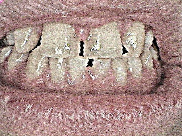 Dental Bridges Before 03