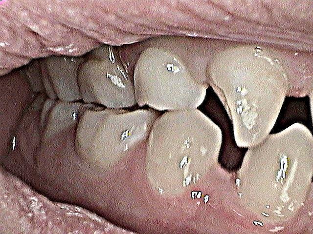 Dental Implants Before 01