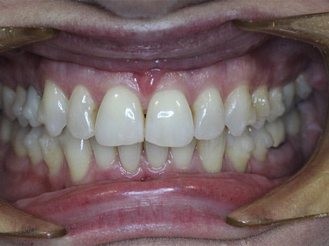Dental Bridges After 02