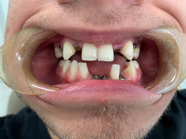 Dental Bridges After 03