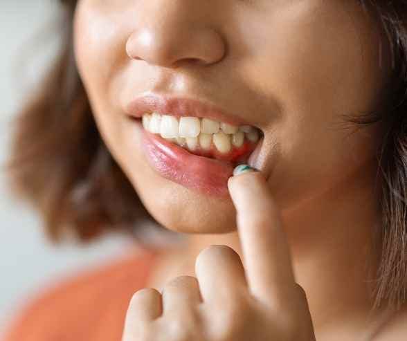 Dry and irritated gums from vaping with Invisalign