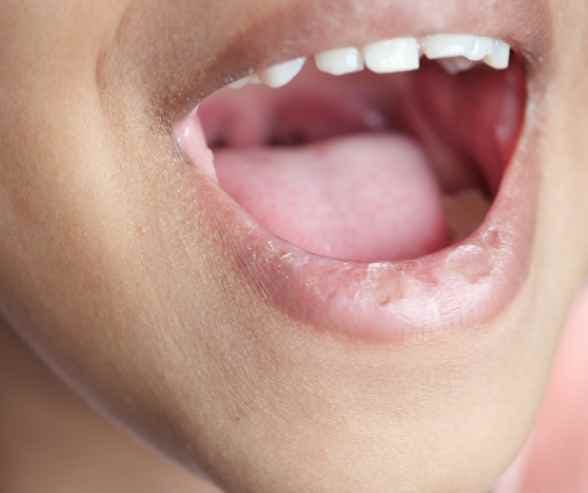 Dry mouth caused by vaping during Invisalign treatment