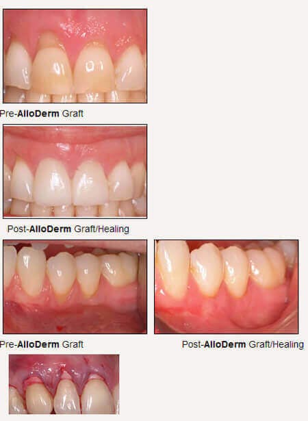 gingival graft alloderm