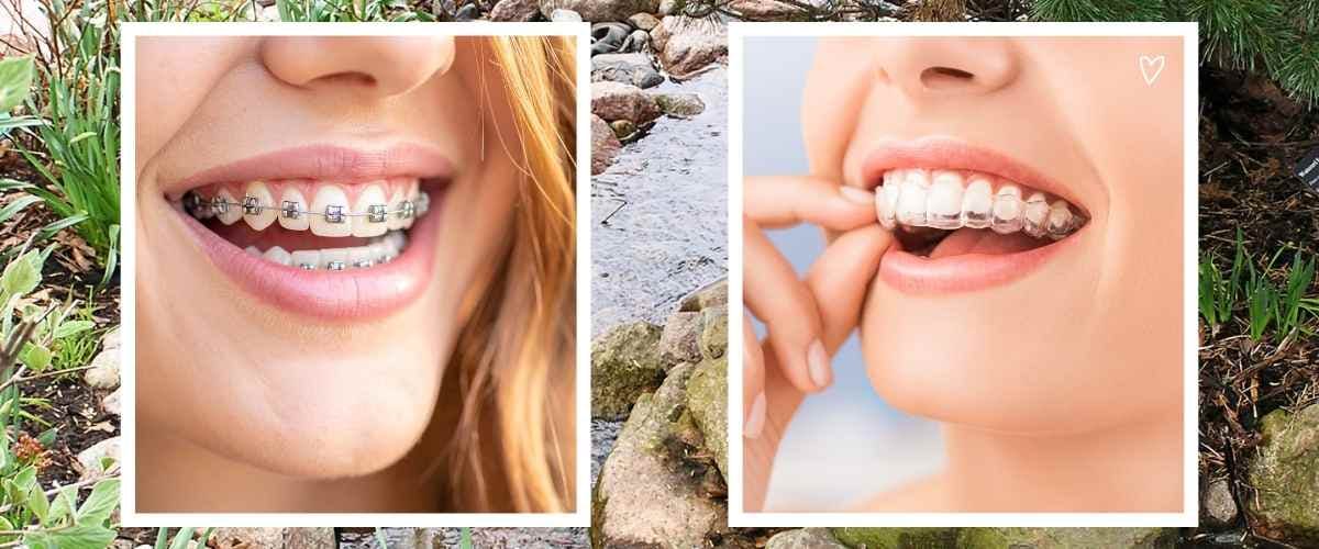 No Braces, More Flexibility: 5 Reasons Adults Choose Invisalign