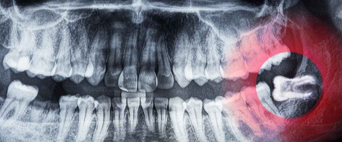 Wisdom Teeth Removal in North York: Signs You Need Extraction and Recovery Tips