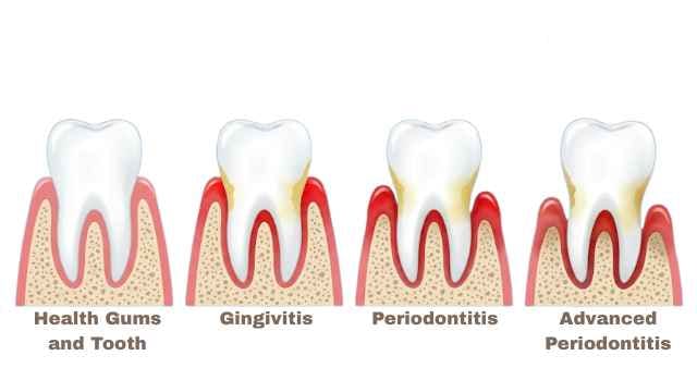 Diagram of progressive stages of periodontal disease