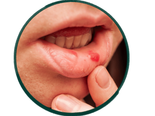 Unexplained oral sores